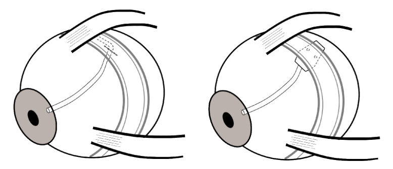 Post-Surgical Glaucoma