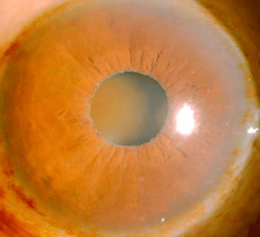 Approach to Exfoliation Syndrome and Exfoliation Glaucoma