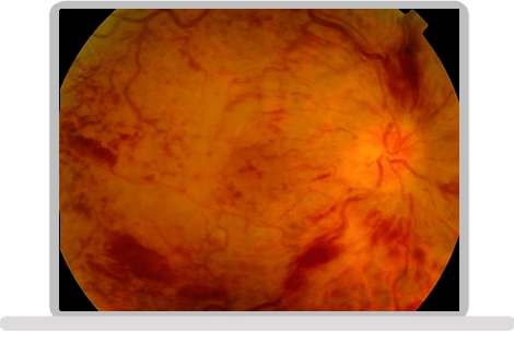 Neovascular Glaucoma