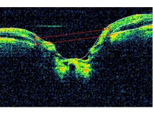 OCT in Glaucoma