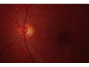 Ocular Hypertension