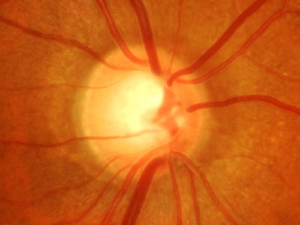 Clinical Examination of the Optic Nerve