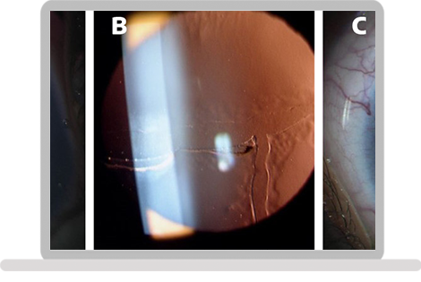 Primary Congenital Glaucoma