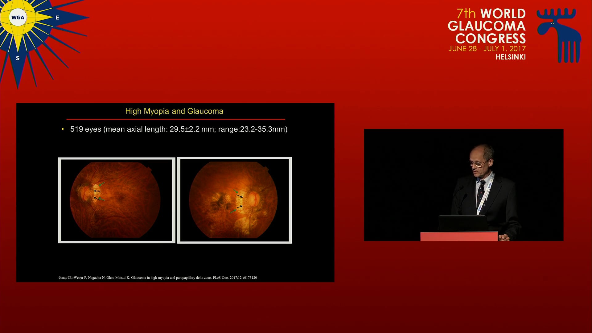 World Glaucoma Association High myopia and glaucoma. Aspects in ...